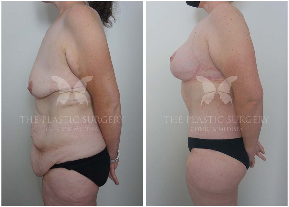 Mummy makeover at Dr Reddy Sydney&#039;s clinic, procedure results 60, side view