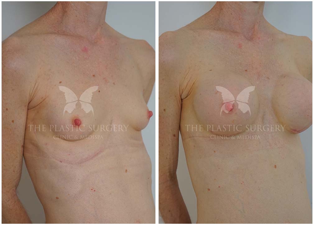 Before and after gallery, breast augmentation surgery 10.1, angle view