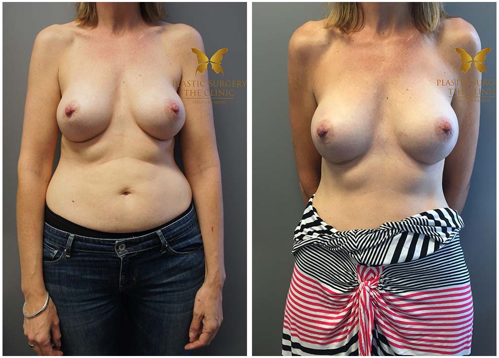 Before and after breast augmentation 02, front view, TPSC