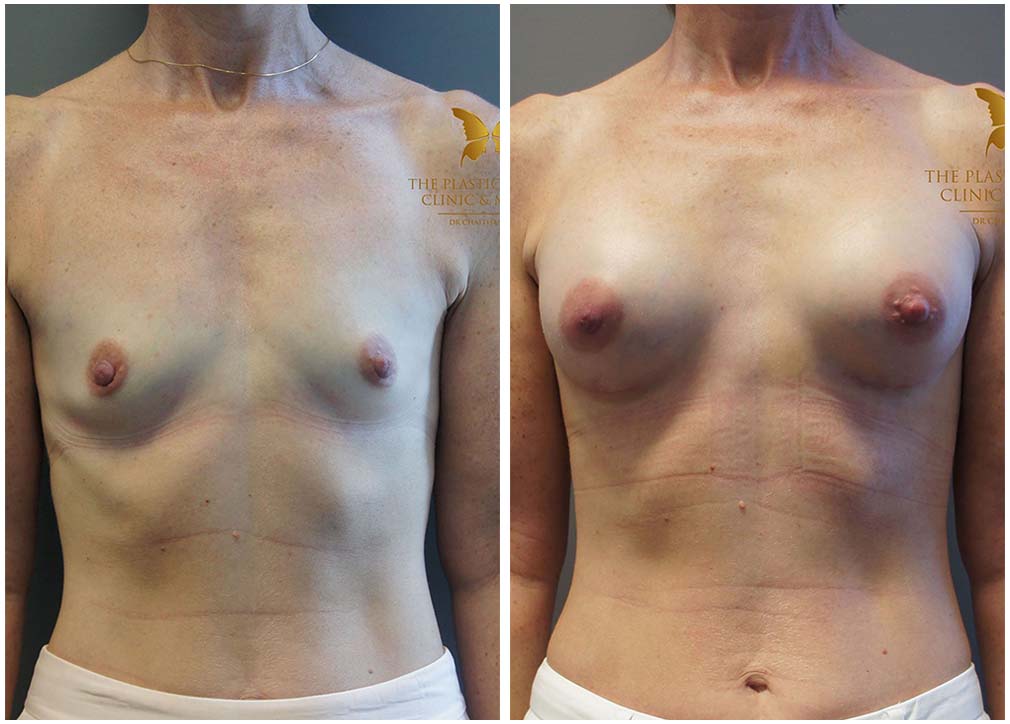 Breast augmentation 06, before and after, front view