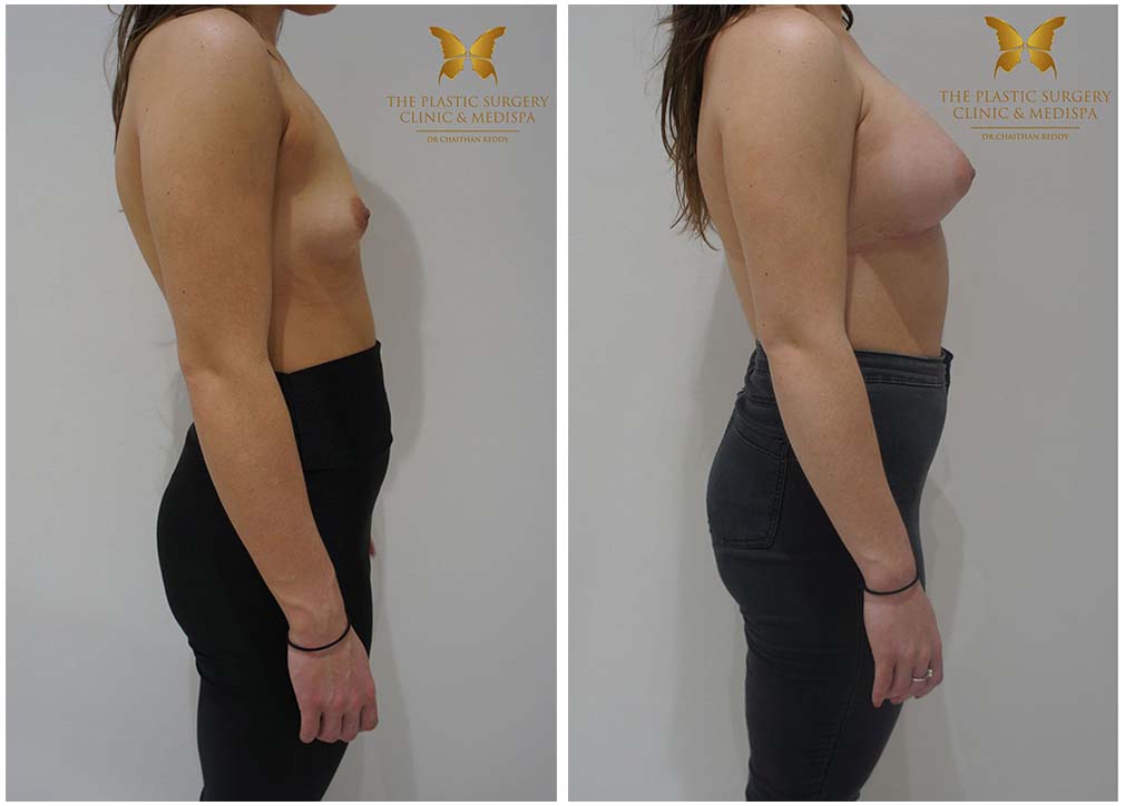 Before and after breast implants surgery 7.2, Dr Reddy