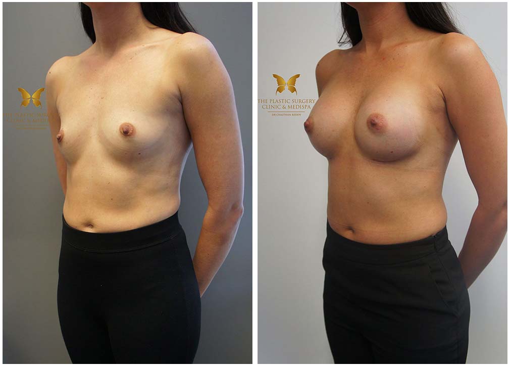 Before and afters gallery, breast augmentation surgery, Dr Chaithan Reddy