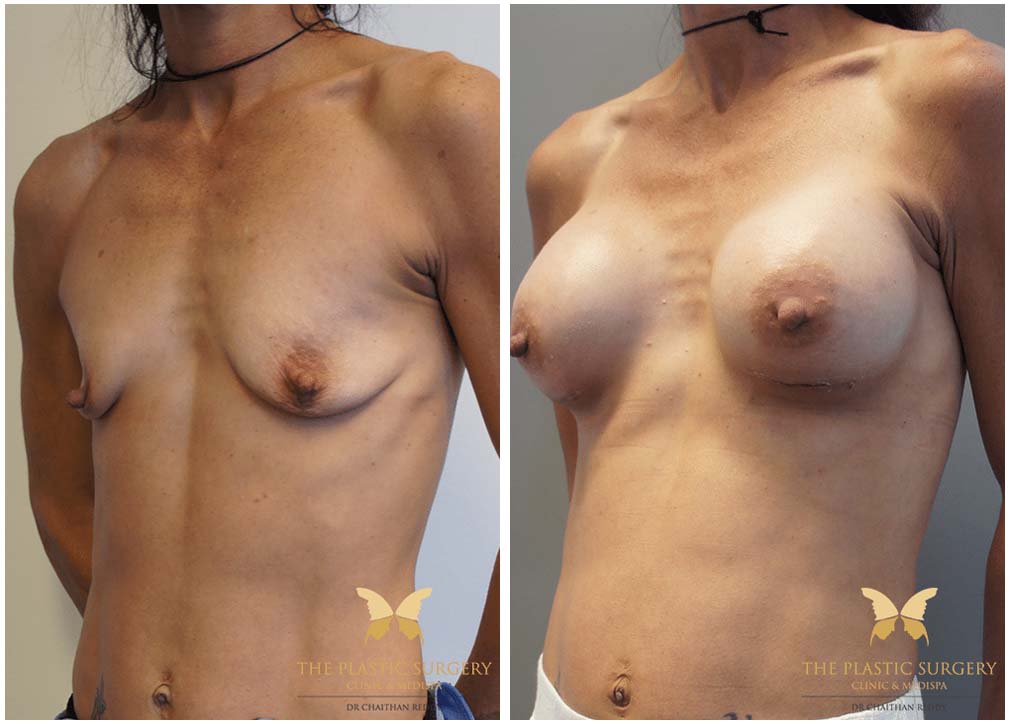 Breast augmentation with implants 9.1, Dr Reddy Sydney &amp; Central Coast