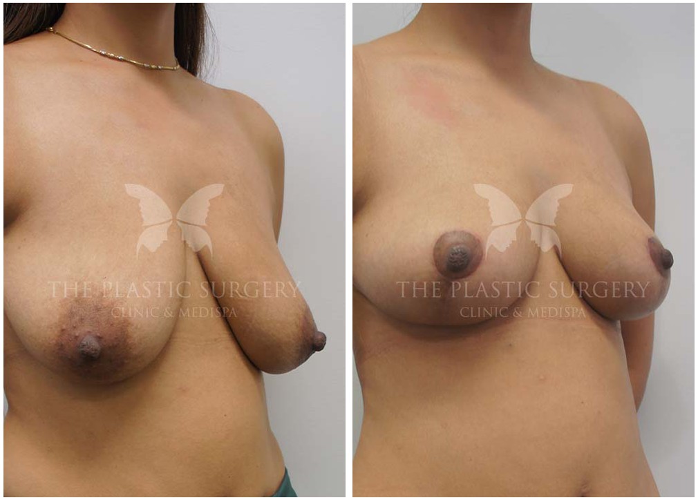 Breast fat grafting, before and after 06, angle view