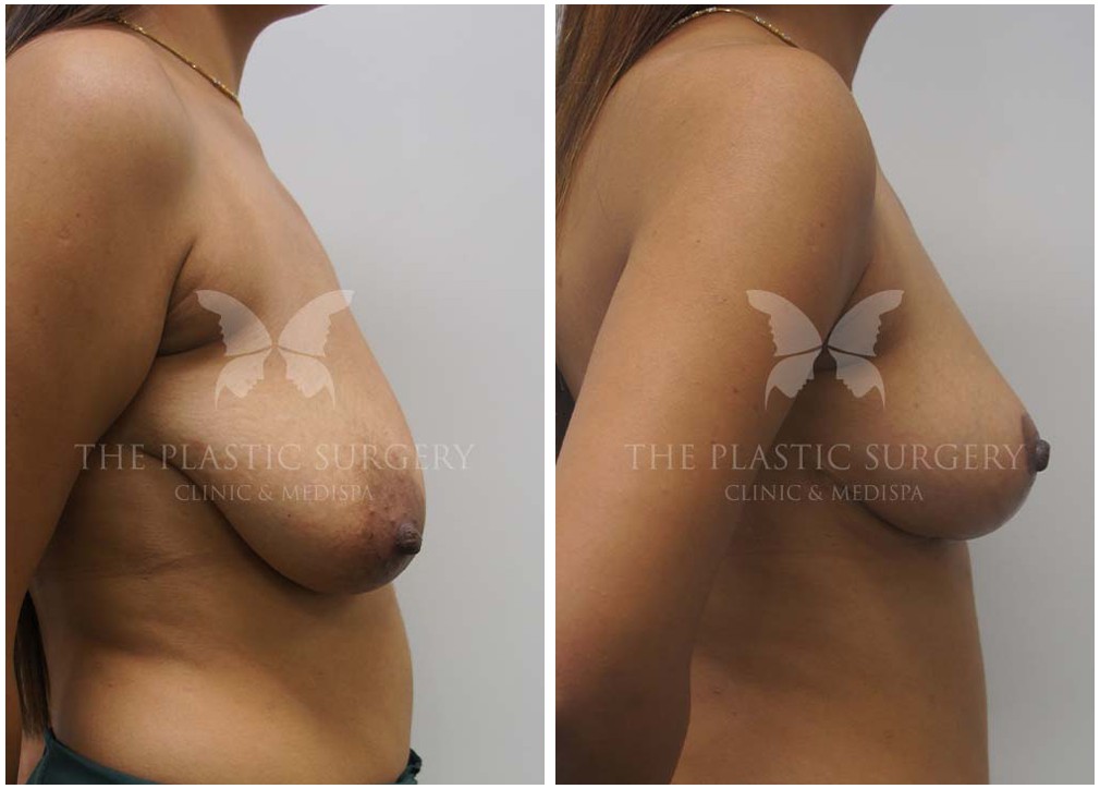 Patient before and after breast fat transfer 07, TPSC