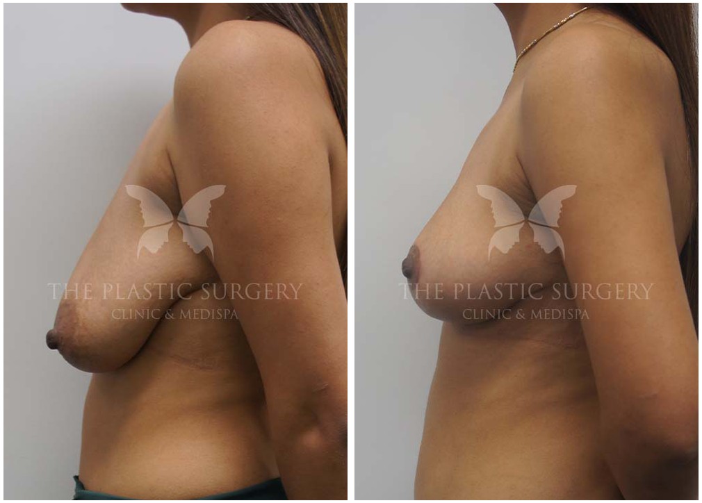 Before and afters 09, breast fat grafting, Dr Reddy clinic Sydney