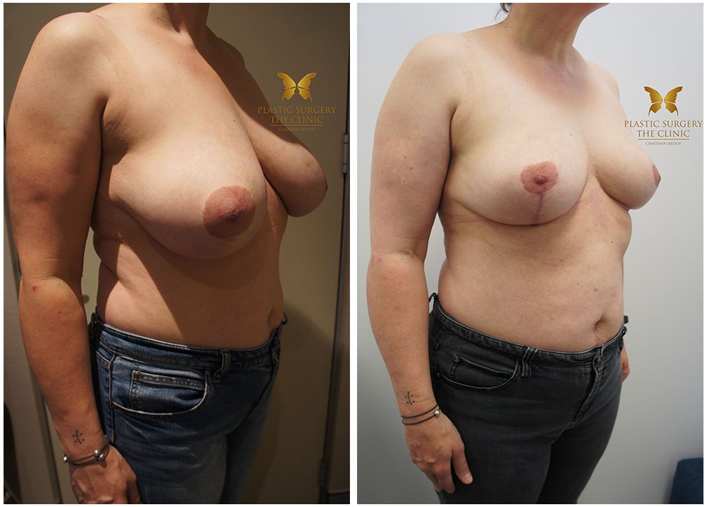 Before and after breast reduction 06, TPSC Sydney