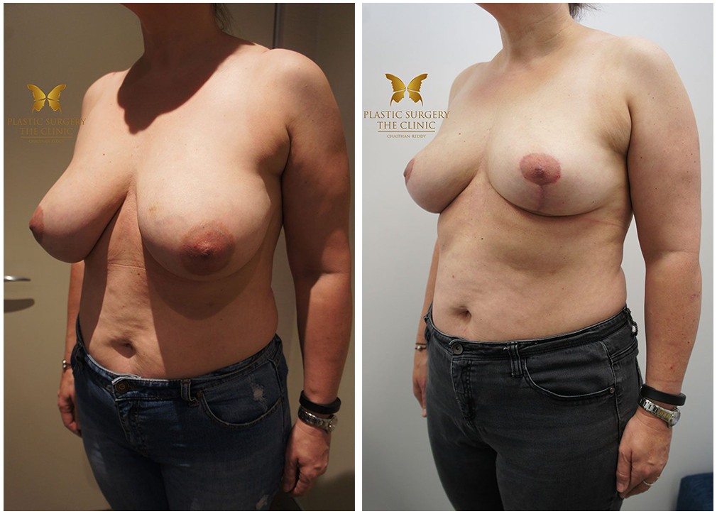 Breast reduction surgery results 08, TPSC