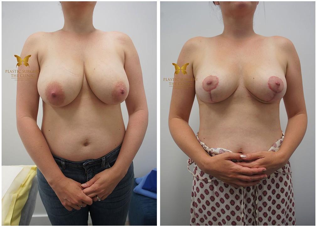Patient before and after breast reduction 09, TPSC Sydney