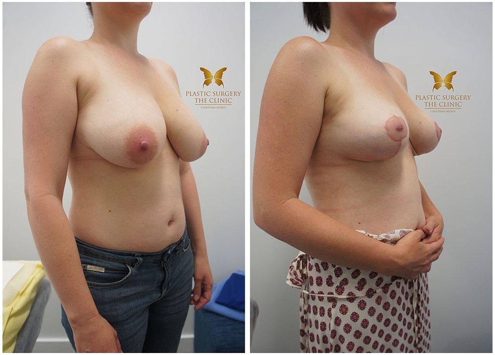 Breast reduction, before and afters 10, Dr Chaithan Reddy