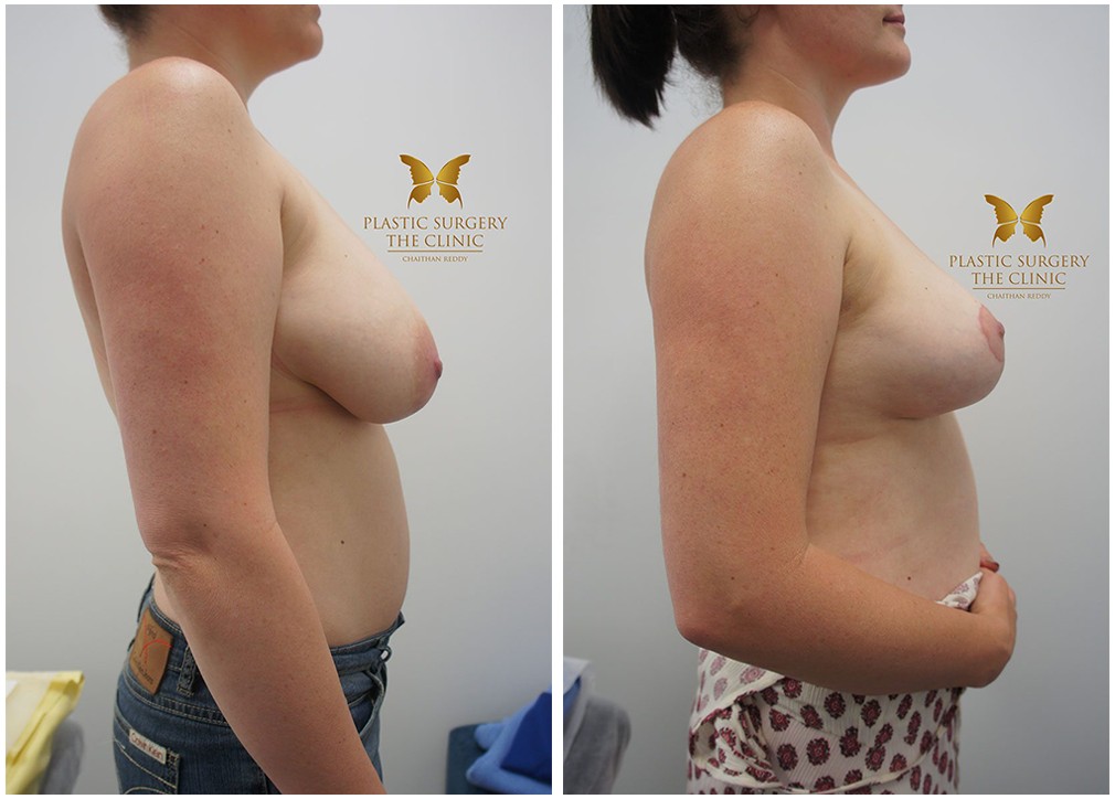 Dr Reddy patient, breast reduction before and after 11