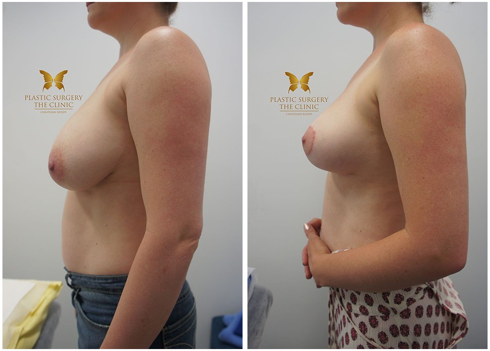 Breast reduction results 13, The Plastic Surgery Clinic