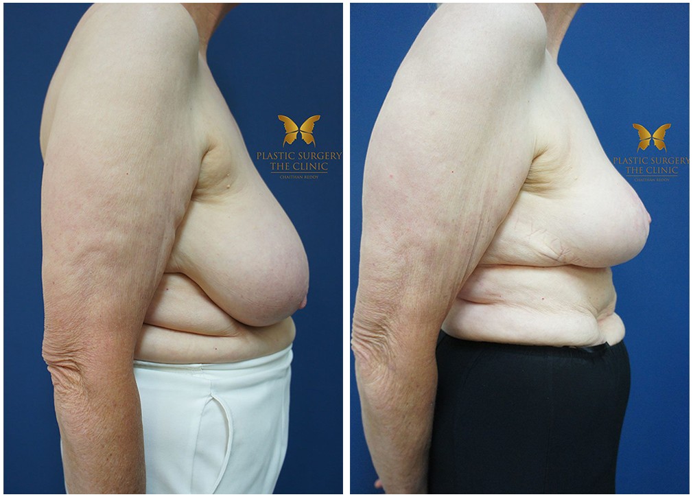 Before and afters 19, breast reduction surgery, Dr Reddy Sydney &amp; Central Coast