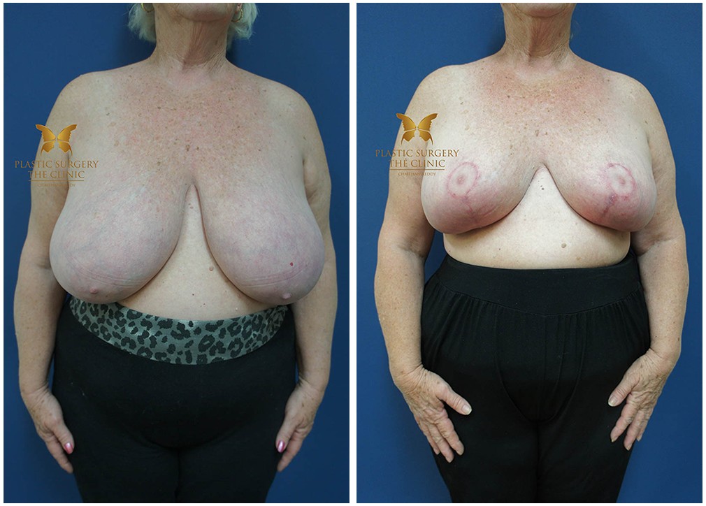 Before and after breast reduction 21, TPSC Sydney