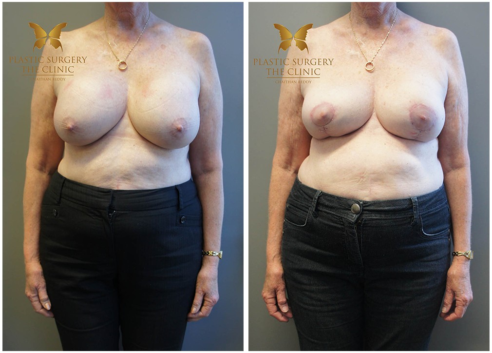Patient before and after breast reduction 30 Dr Reddy