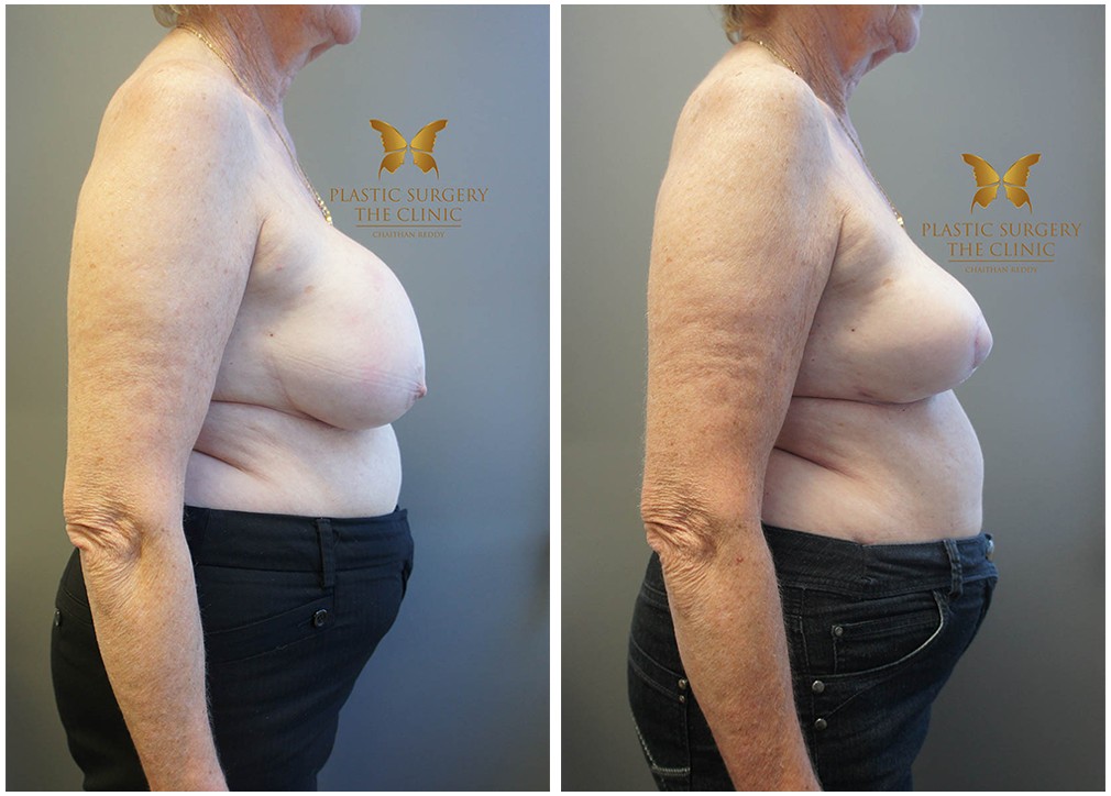 Older female patient before and after breast reduction surgery 32, TPSC Sydney Clinic
