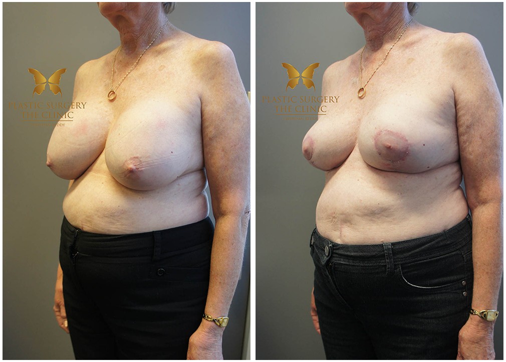 Before and after breast reduction 33, The Plastic Surgery Clinic
