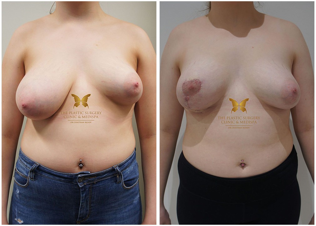 Patient before and after breast reduction and asymmetry correction at the same time 39