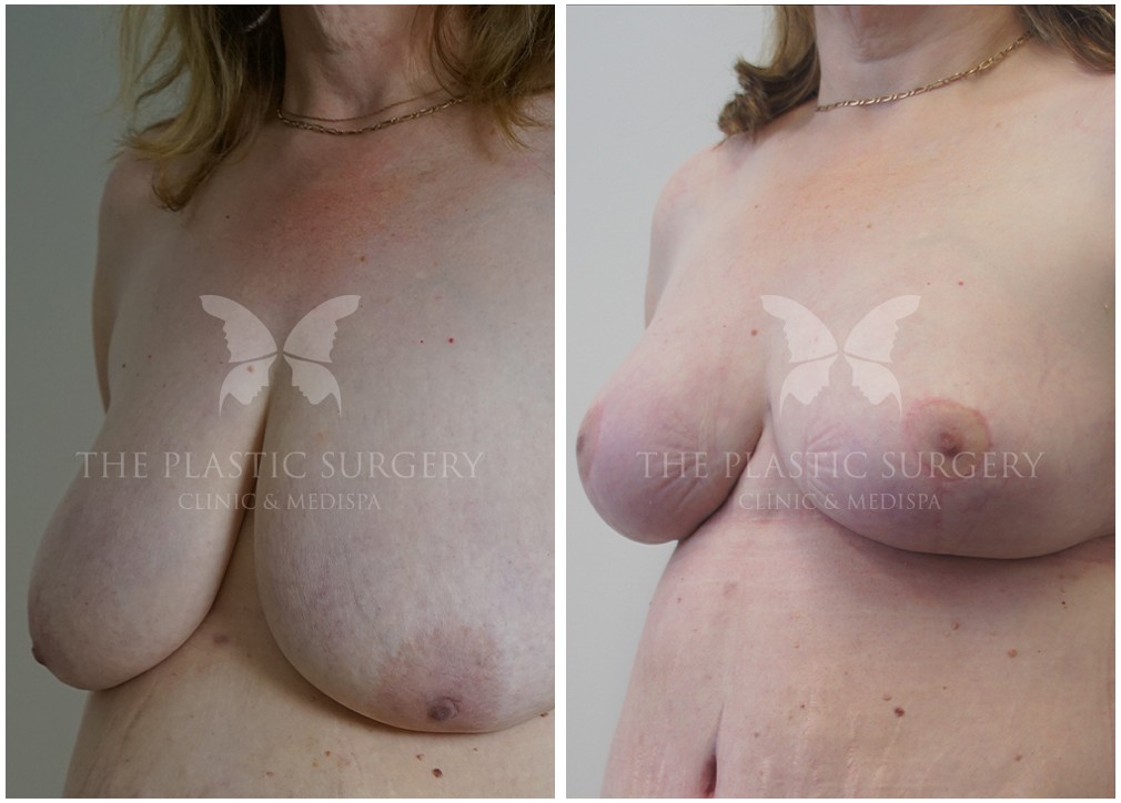 Dr Reddy patient before and after breast reduction 46, TPSC Sydney