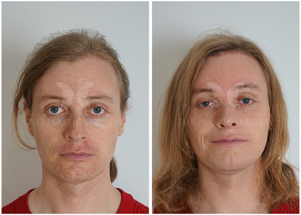 Dr Reddy patient before and facial feminisation surgery 09, front view