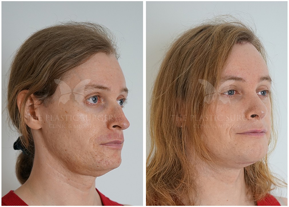 Before and after brow lift 10, The Plastic Surgery Clinic