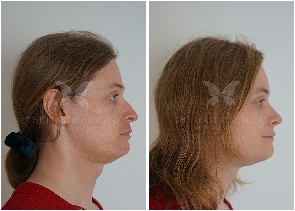 Facial feminisation at TPSC in Sydney, before and after 11, Dr Reddy