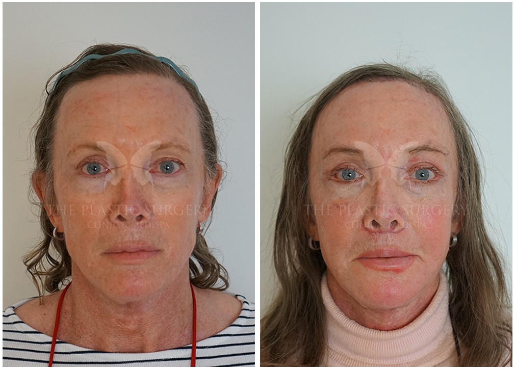 Patient before and after forehead and brow prominence reduction 13, TPSC