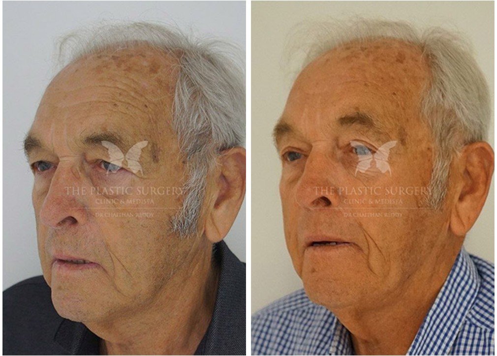 Before and after eyelid surgery 01, male patient, Dr Reddy Sydney &amp; Central Coast