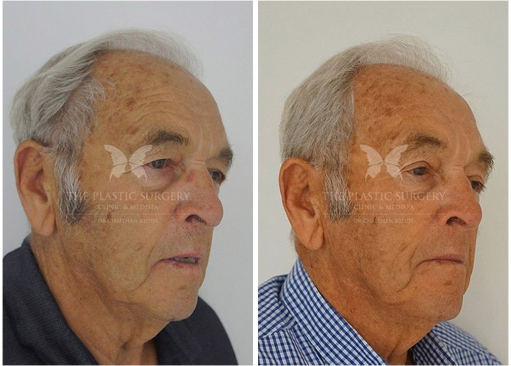 Blepharoplasty patient, before and after 02, Dr Reddy plastic surgery Sydney