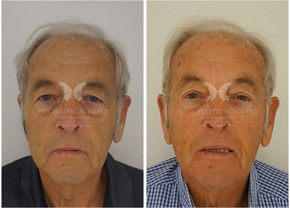 Older male patient before and after eyelid surgery 03, front view