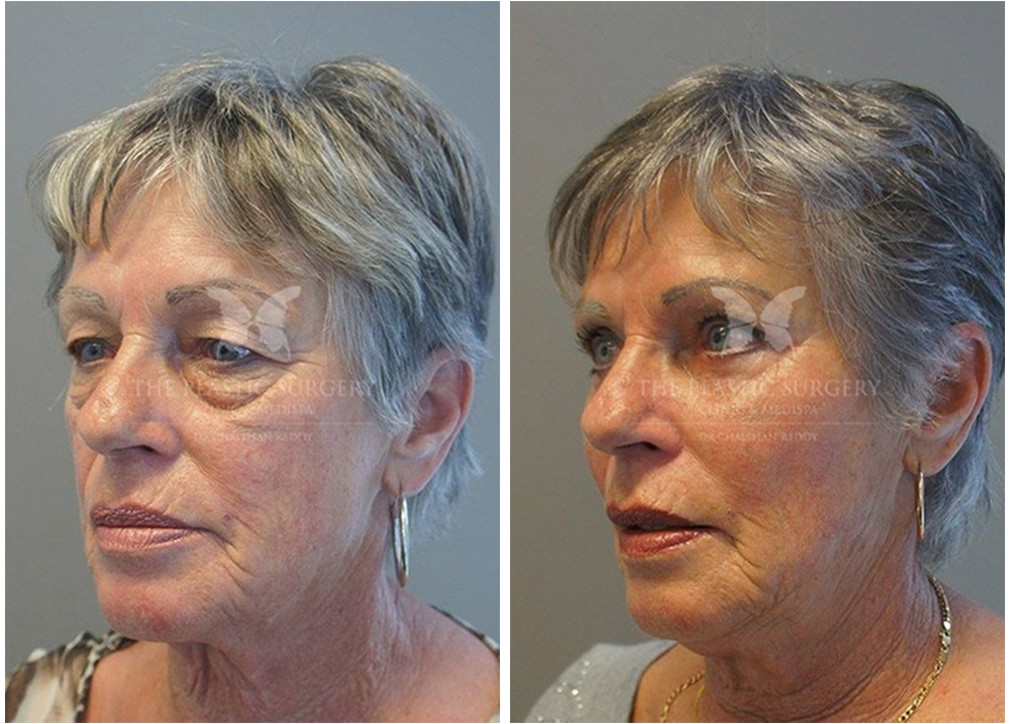 Blepharoplasty before and after 04, Dr Reddy Sydney, angle view
