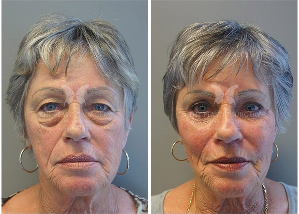 Eyelid Surgery Results 06 TPSC