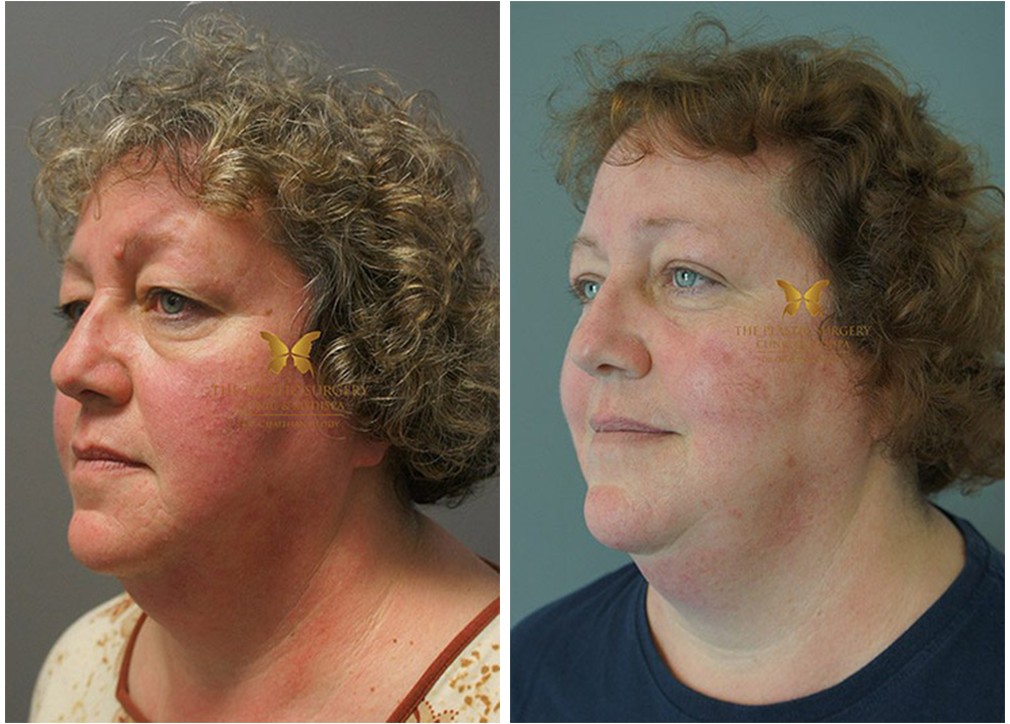 Blepharoplasty before and after 07, Dr Chaithan Reddy