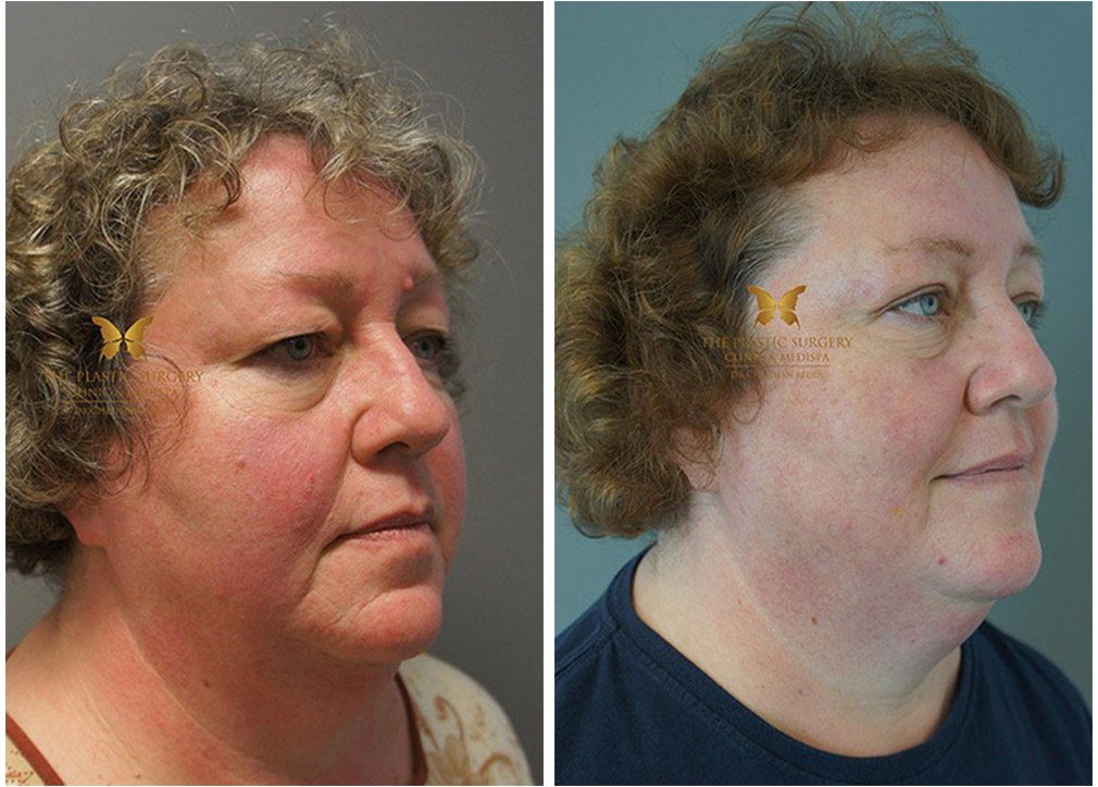 Female patient before and after eyelid surgery 08, TPSC Sydney