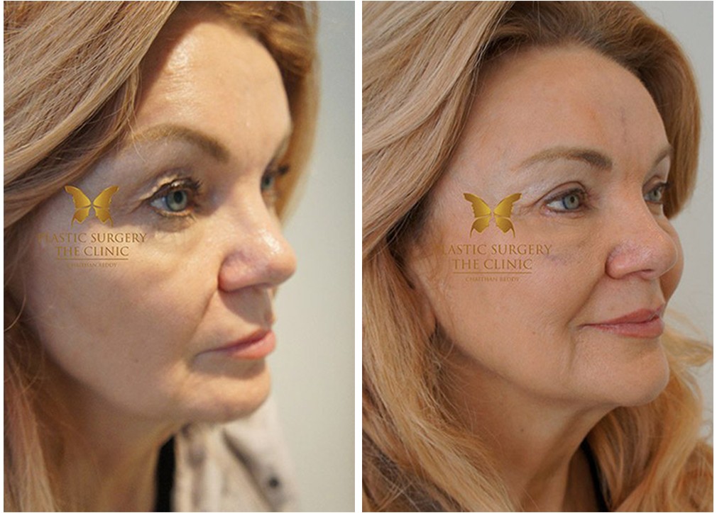 Before and afters, eyelid surgery 11, Dr Reddy Sydney