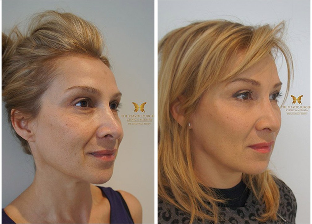 Blepharoplasty surgery before and after 12, Dr Reddy