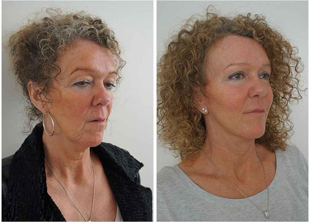 Before and after Blepharoplasty 16, female patient, Dr Chaithan Reddy