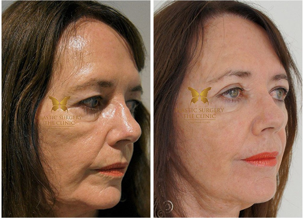 Blepharoplasty surgery, female patient, before and after 20