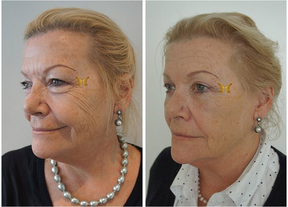 Dr Reddy, eyelid surgery before and after 21, angle view