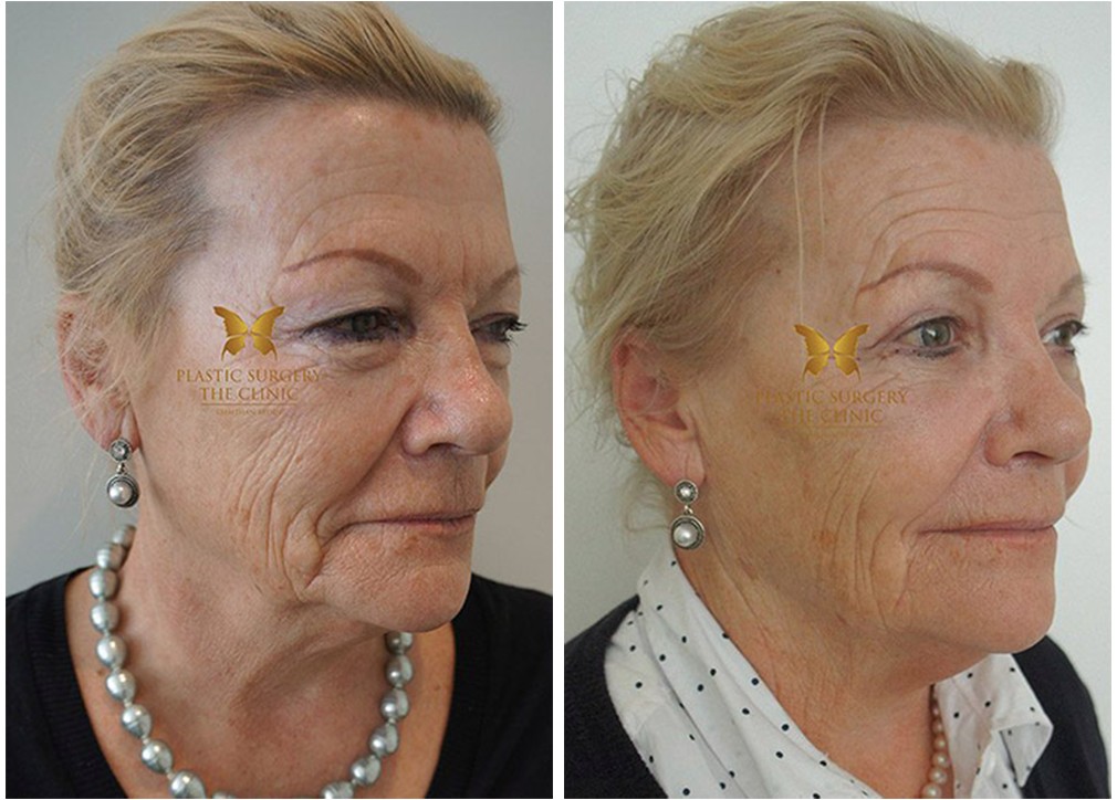 Patient before and after Blepharoplasty 22, TPSC Sydney