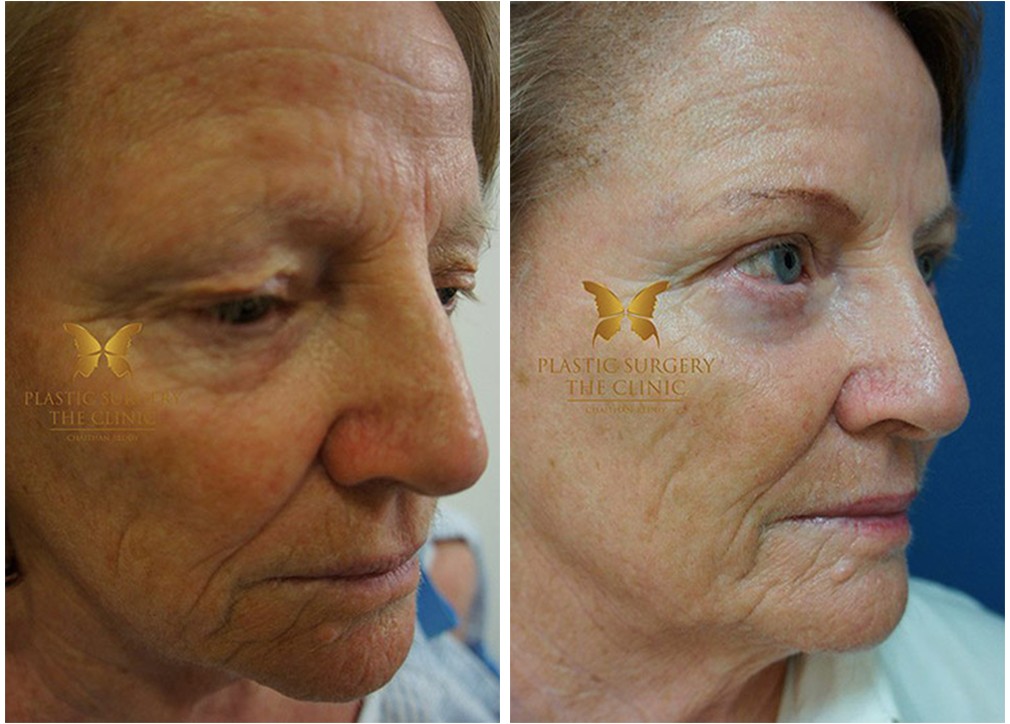 Blepharoplasty results, before and afters 24, Dr Reddy Sydney
