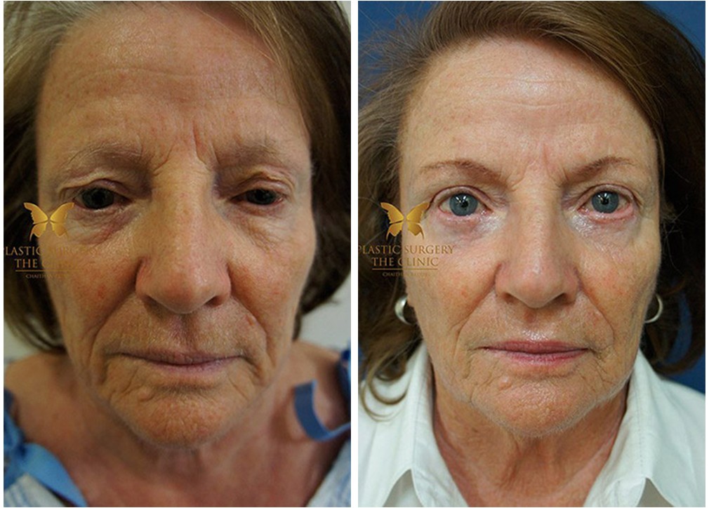 Female patient before and after eyelid surgery 25, Dr Reddy