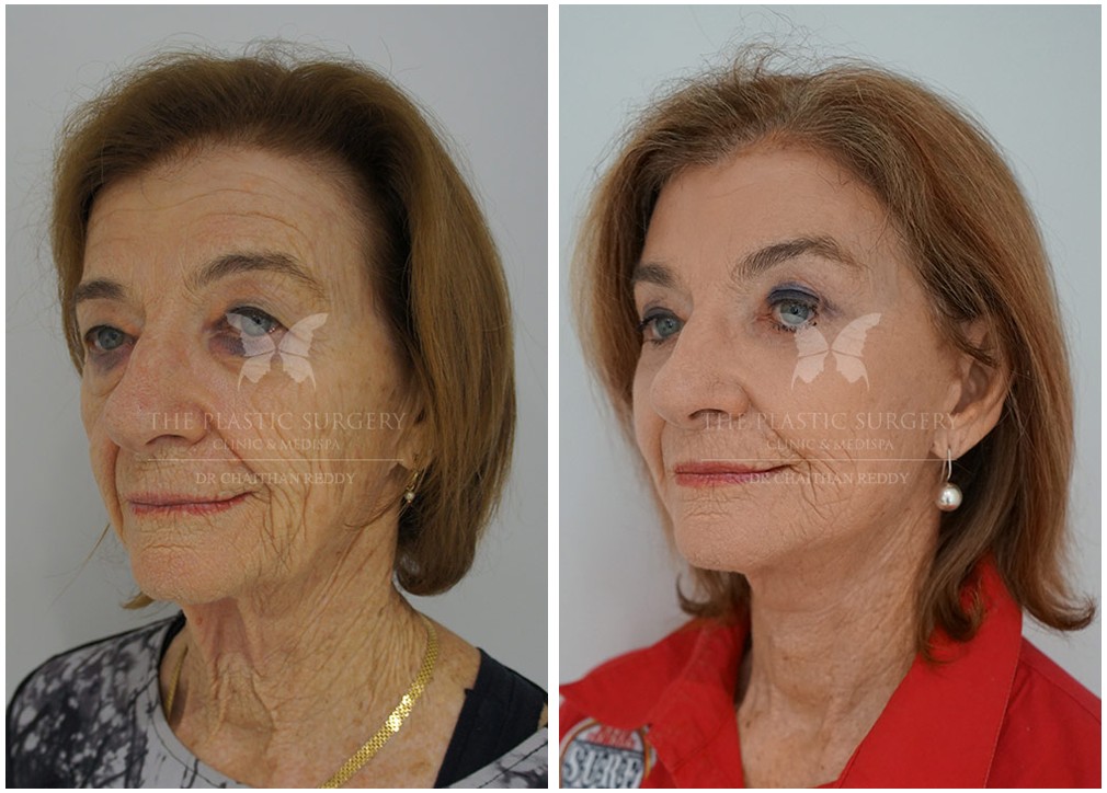 Eyelid surgery results 29, female patient, front view, The Plastic Surgery Clinic