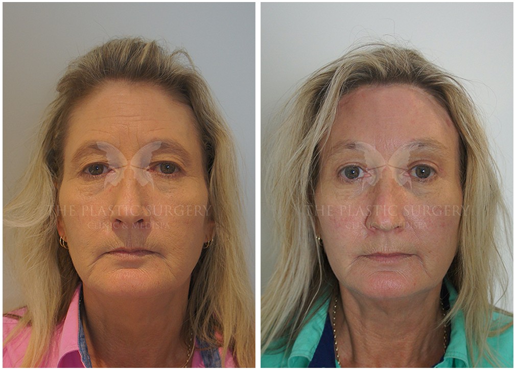 Before and after eyelid surgery 31, The Plastic Surgery Clinic
