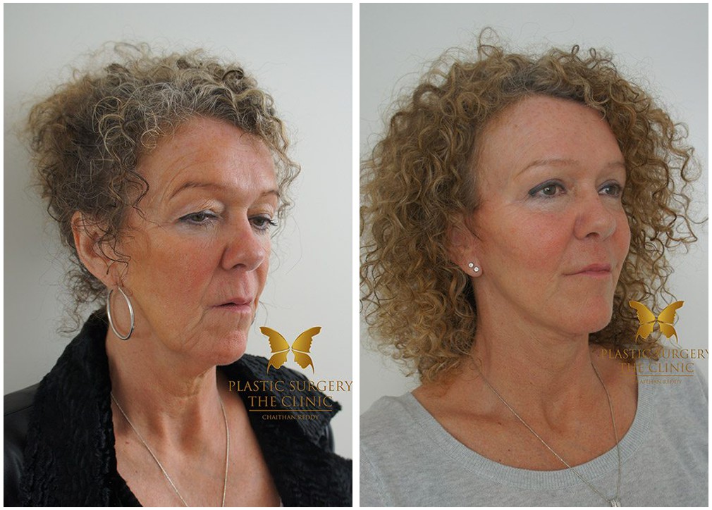 Before and after face and neck lift 02, TPSC Sydney &amp; Central Coast