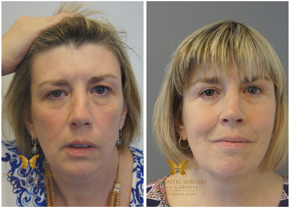 Before and after facelift and neck lift surgery 09, front view
