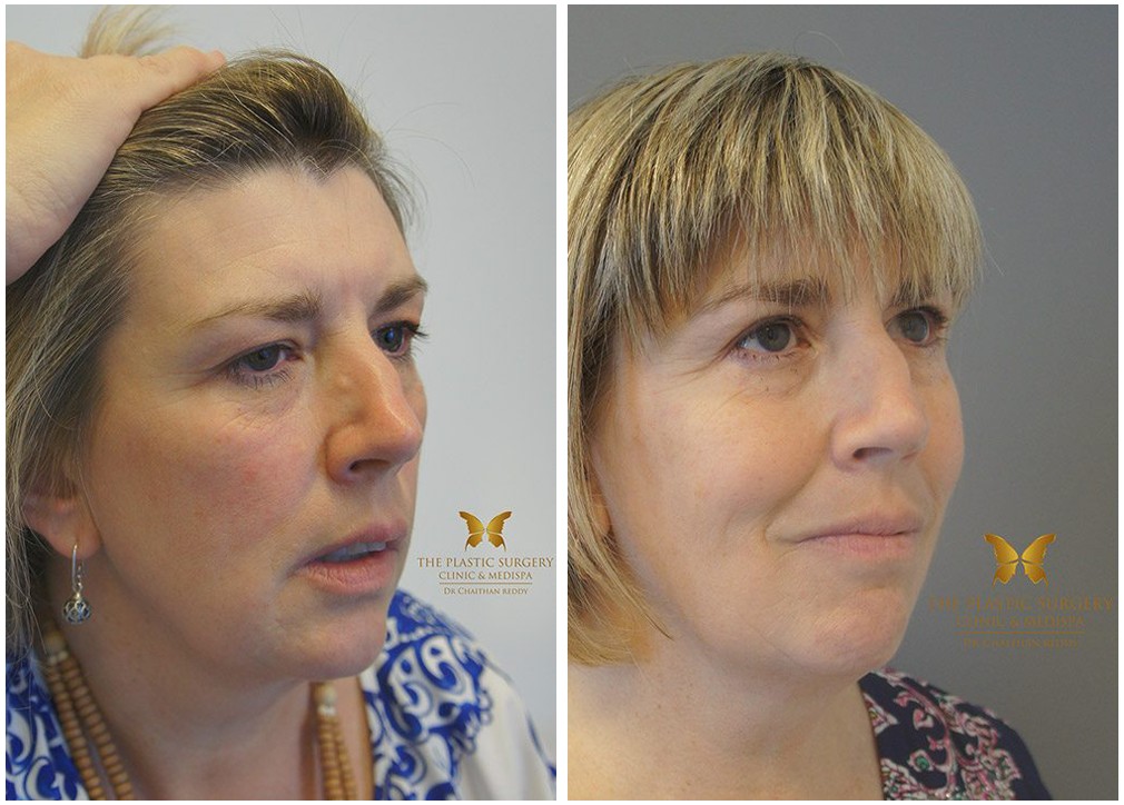 Face and neck lift 10, before and afters, Dr Reddy