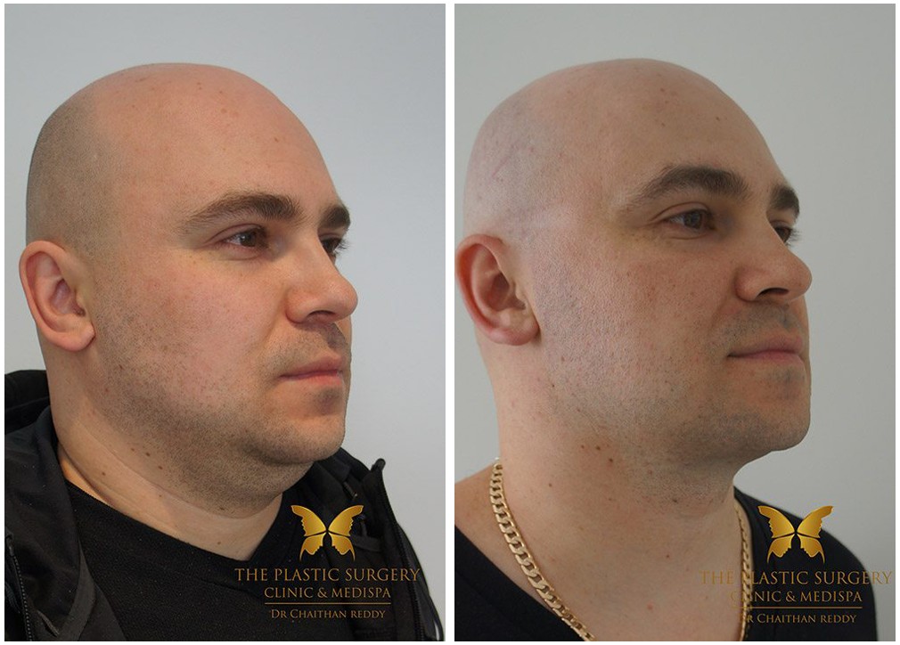 Before and after gallery, face and neck lift 16, Dr Reddy