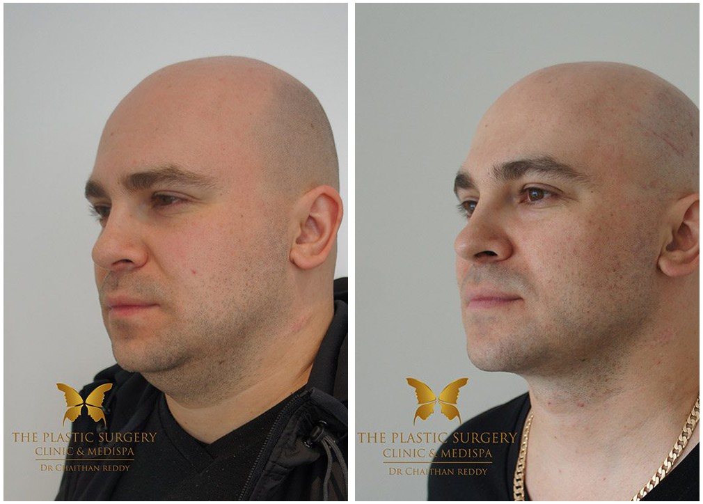 Facelift and neck lift before and after 18, TPSC