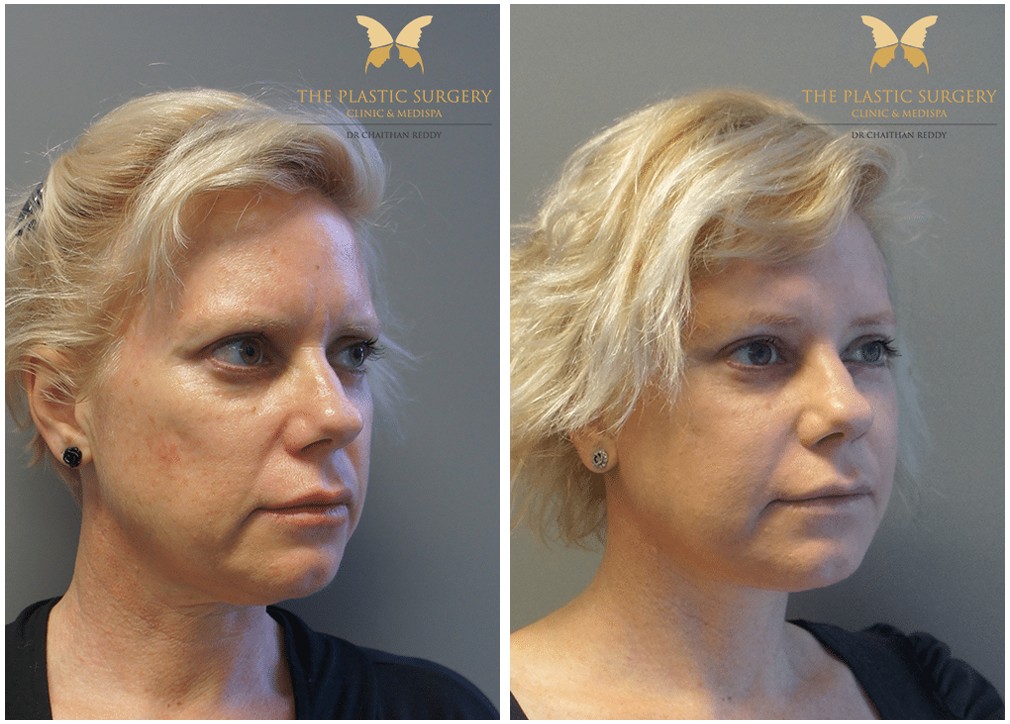 Before and after face lift and neck lift 21, TPSC